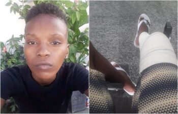 Mulher Lésbica é agredida e tem o joelho quebrado ao tentar usar o banheiro feminino de um Bar